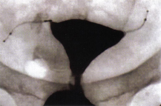 انسداد الأنابيب ويؤكد 12 في الأسابيع التي تلت Essure ® (الحمل المستكن ، شركة ماونتن فيو ، كاليفورنيا) microinsert على تنسيب من hysterosalpingogram.