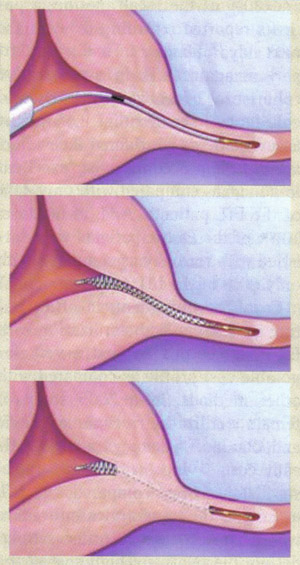 التنسيب إدراج الجزئي. و® Essure (الحمل المستكن شركة ماونتن فيو ، كاليفورنيا) لإجراء الولادة سيطرة دائمة
