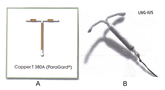 Deux types de dispositifs de contraception intra-utérine sont disponibles dans les États-Unis. A: TCu380A, ParaGard ®; B: système intra-utérin libérant du lévonorgestrel (LNG-IUS), Mirena ®