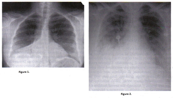 Figure 1. Radiographie du thorax de la pneumonie à pneumocoques droit; Figure 2. Radiographie du thorax de la femme enceinte à la varicelle pneumonie. Note les infiltrats nodulaires et interstitiels similaires à d'autres pneumonies virales.