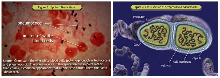 Figure 3. Coloration de Gram des crachats; Figure 4. Coupe de <i> Streptococcus pneumoniae / i> »><br /> Figure 3. Coloration de Gram des crachats; Figure 4. Coupe de <i>Streptococcus pneumoniae</i> </div>
<p></center></p>
<p> certaine adaptation de la fonction immunitaire pendant la grossesse peuvent également jouer un rôle dans la susceptibilité à la pneumonie et de son évolution clinique. T cytotoxiques des cellules sont supprimées, et le type T-helper 2 cellules prédominent sur le type T-helper cellules 1 par un ratio de 4:1, ce qui entraîne une diminution de la sécrétion de l’interleukine-2, l’interféron γ-et facteur de nécrose tumorale- β. l’activité des cellules tueuses naturelles est également diminué <sup><a href=