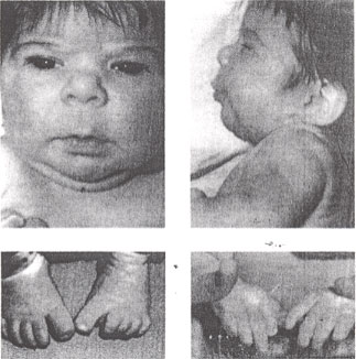 Hidantoína síndrome fetal: rasgos faciales - repunte nariz, hipoplasia mediofacial suave, largo con labio superior delgado y bermellón frontera inferior distal hipoplasia digital.